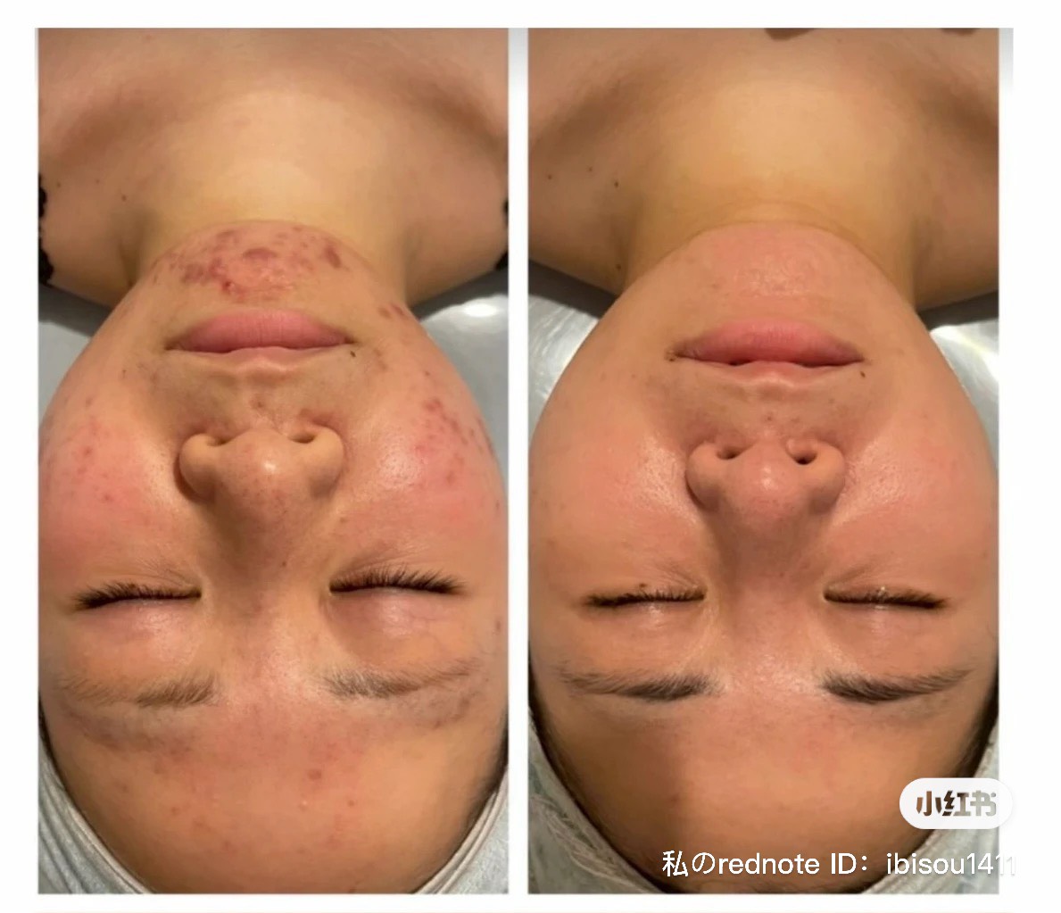 ニキビ・赤み改善